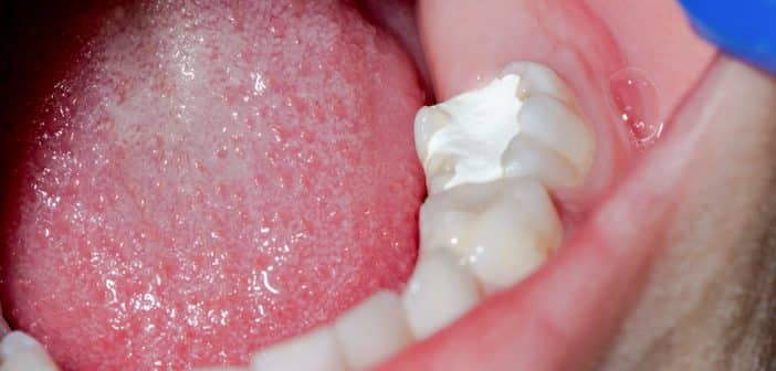 Santéplombage Dentaire Cause De Prostate Chez Les Hommes