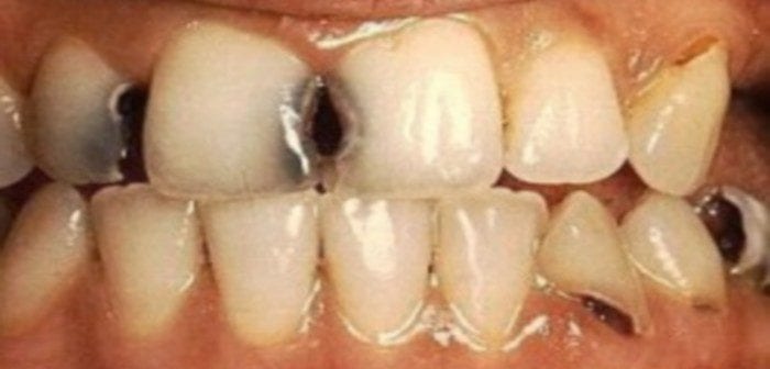 Santé: Une Mauvaise Hygiène Dentaire Augmenterait Les Risques Du Cancer Du Foie