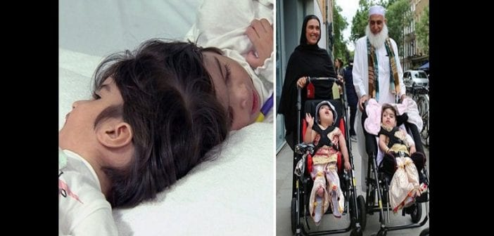 L’histoire Touchante ,safa Et Marwa,les Sœurs Siamoises, Séparées Après ,50 Heures D’opération