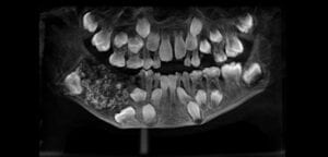 Inde : Des Médecins Découvrent 526 Dents Dans La Bouche D’un Garçon De 7 Ans (Vidéo)