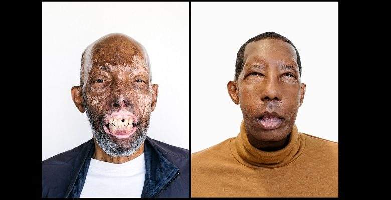 Après 18 interventions chirurgicales, il devient le premier Afro-Américain à recevoir une greffe du visage (photos)
