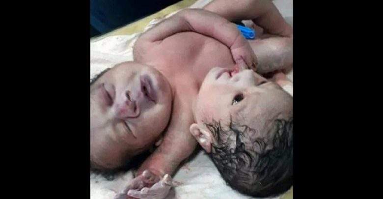 Inde: une femme donne naissance à des «jumeaux siamois rares»