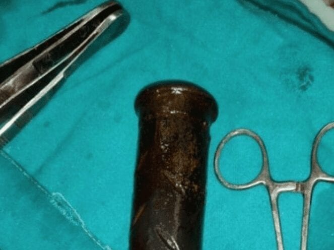 Des médecins retirent une poignée de moto qui était prisonnière du vagin d’une femme depuis 2 ans