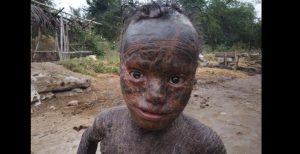 Agé De 10 Ans, Il Souffre D’une Maladie Qui Lui Fait Perdre La Peau Comme Un Reptile (Photos)