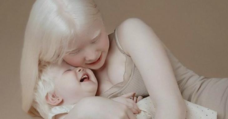 Ces Deux Soeurs Albinos Ont 12 Ans D’écart Et Leurs Photos Font Le Tour Du Web