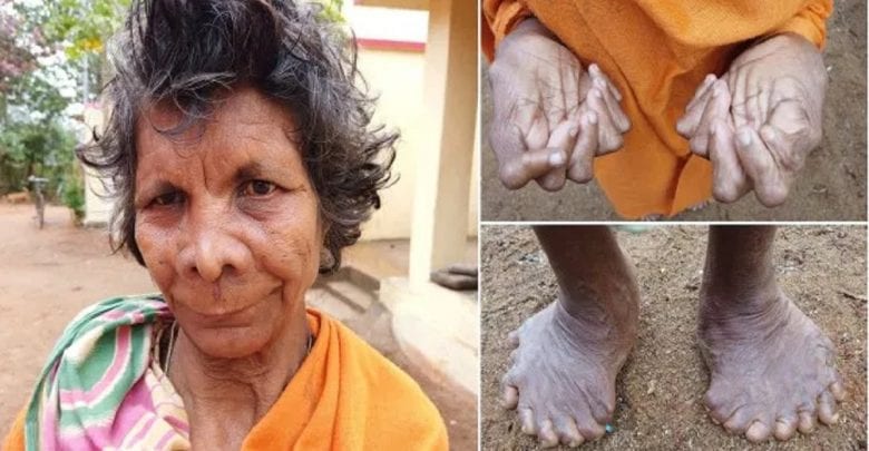Inde découverte d’une femme 31 doigts et orteilsPHOTOS - Inde: découverte d’une femme avec 31 doigts et orteils-PHOTOS