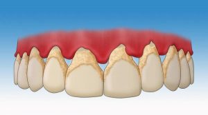 Recette : Enlevez Le Tartre De Vos Dents Grâce À Ce Mélange Naturel