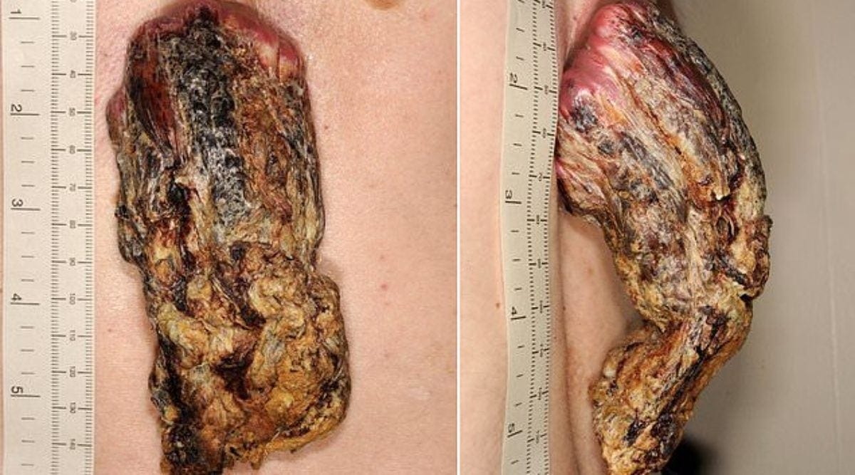 Les médecins découvrent une corne de 14 centimètres sur le dos d’un homme
