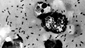 Une Autre Maladie Bien Connue Refait Surface Dans Le Pays…Une Infection Bactérienne Rare Mais Grave