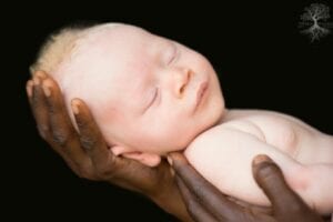 Cameroun : Les Organes D&Rsquo;Albinos Vendus Chers