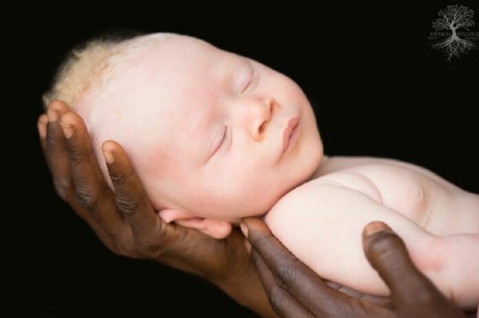 Cameroun : Les Organes D'Albinos Vendus Chers