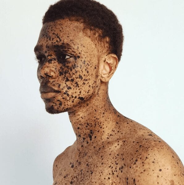 Yeezy : Kanye West repère un jeune haïtien atteint de vitiligo