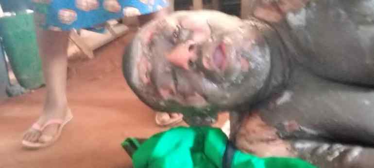 Togo : un militaire brulé gravement à l’huile chaude par sa femme