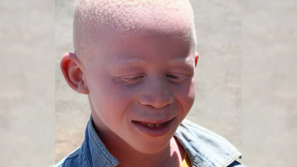Albinisme : La Lutte Contre La Stigmatisation Se Poursuit