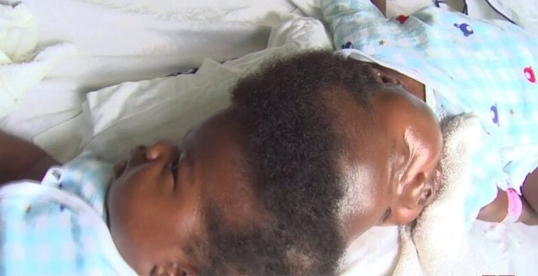 Ghana : 135 médecins mobilisés pour séparer des siamois reliés à la tête (vidéo)