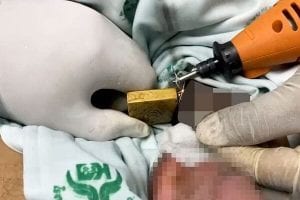 Thaïlande : Le Pénis D’un Homme Coincé Dans Un Cadenas Pendant Deux Semaines