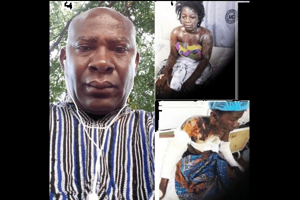 Ghana : Un Homme De La Cinquantaine Verse De L&Rsquo;Acide Sur Son Amante De 22 Ans