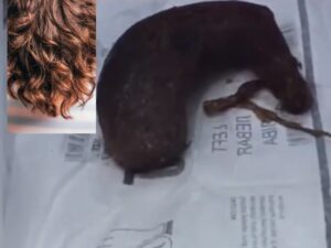 Insolite : Près De 3Kg De Cheveux Retirés De L&Rsquo;Estomac D&Rsquo;Une Fillette (Vidéo)