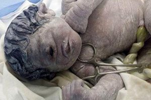 Égypte: Une Femme Donne Naissance À Un Bébé Ayant Un Œil