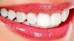 Blanchiment Des Dents : 6 Astuces De Blanchiment Simples Et Naturelles