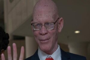 Un Albinos En Malawi Élu Député, Une Première Dans L’histoire Du Pays