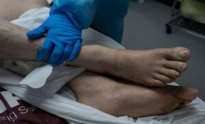 Erreur Médicale : Le Chirurgien A Amputé La Mauvaise Jambe Du Patient