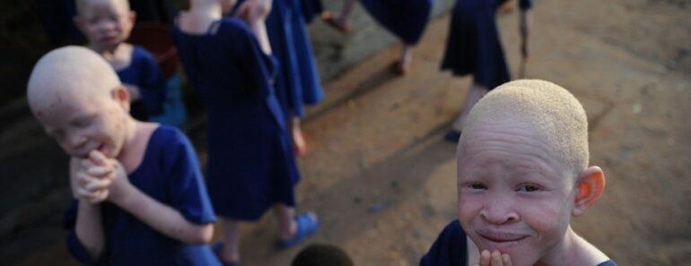 Burundi : un albinos de 4 ans tué et démembré