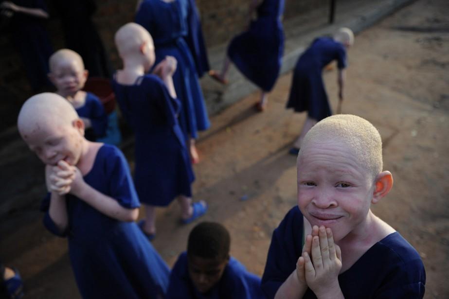 Burundi : Un Albinos De 4 Ans Tué Et Démembré