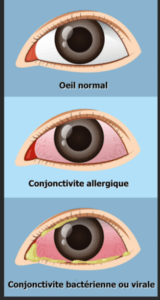 Des Remèdes Efficaces En Cas De Conjonctivite