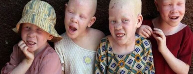 Malawi / Meurtre D&Rsquo;Une Personne Atteinte D&Rsquo;Albinisme : Le Coupable Condamné À 155 Ans De Prison