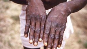 Monkeypox : Le Nigeria A 21 Cas Confirmés