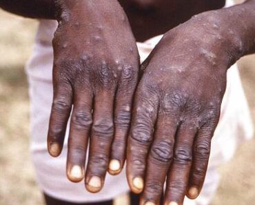 Monkeypox : Le Nigeria a 21 cas confirmés