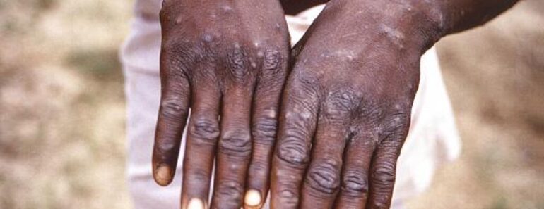 Monkeypox : Le Nigeria A 21 Cas Confirmés