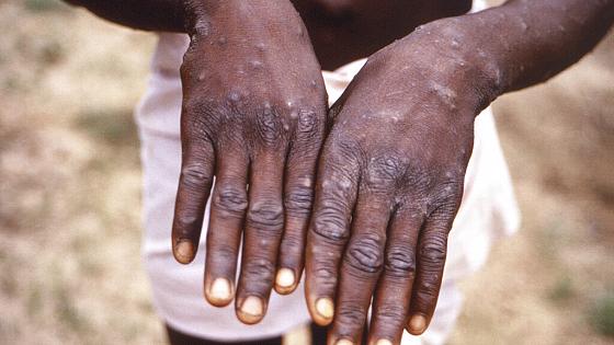 Monkeypox Le Nigeria 21 Cas Confirmes