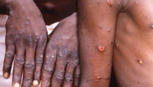 Monkeypox Ou Variole Du Singe : Un Pays D’afrique De L’ouest Enregistre Un Premier Décès