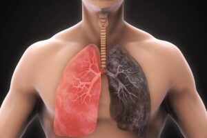 Cancer du poumon : Comment prévenir sa propagation ?