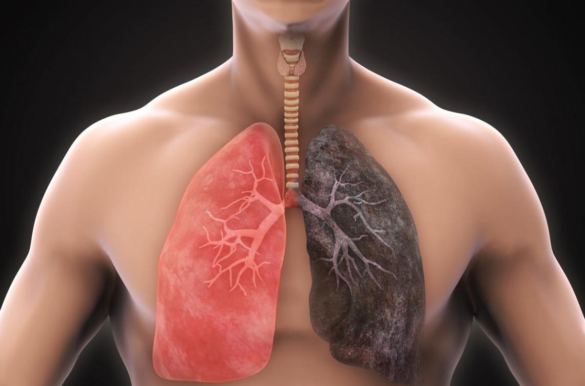 Cancer Du Poumon : Comment Prévenir Sa Propagation ?