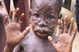 Monkeypox Ou Variole Du Singe  : Une Nouvelle Épidémie À L&Rsquo;Horizon ? L&Rsquo;Oms Répond