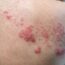 Infections fongiques : c’est quoi ces maladies de la peau et comment les prévenir ?