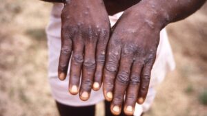 L&Rsquo;Oms Évaluera Si Le Monkeypox Est Une Urgence Sanitaire Internationale