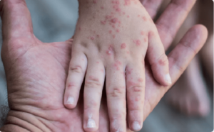 Santé / Grippe De La Tomate, Le Nouveau Virus Qui Attaque Les Enfants : Qu’est-Ce Que C’est ?