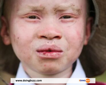 Un Père A Vendu Ses Trois Enfants Albinos Pour 25 Millions De Francs Cfa, Les Faits