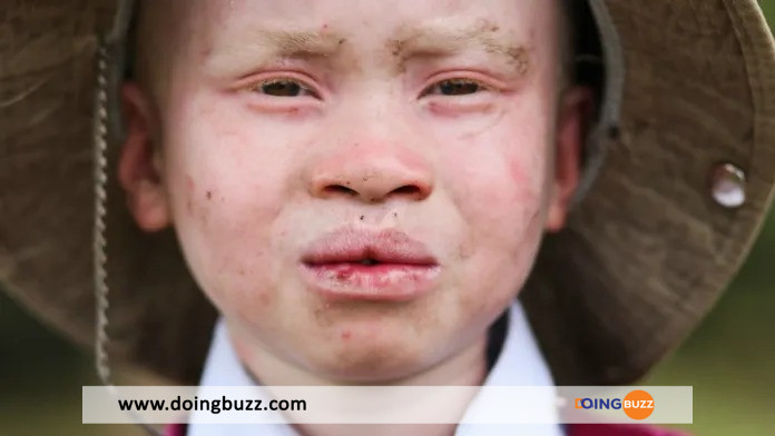 Un Pere A Vendu Trois Enfants Albinos 25 Millions De Francs Cfa Les Faits