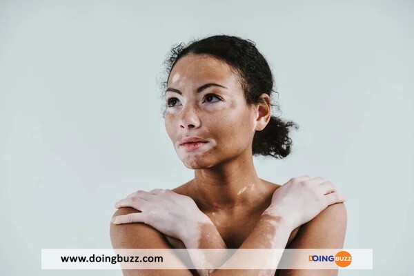 Le Vitiligo, Une Maladie De La Peau Sans Remède ? Que Faire Alors ?