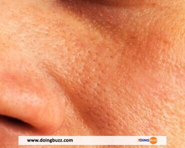 Pores dilatés : Comment les resserrer naturellement pour une peau parfaite ?