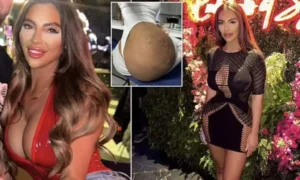 Phénomène Bbl : Une Femme Se Retrouve Avec Des Trous Noirs Dans Les Fesses (Photos)