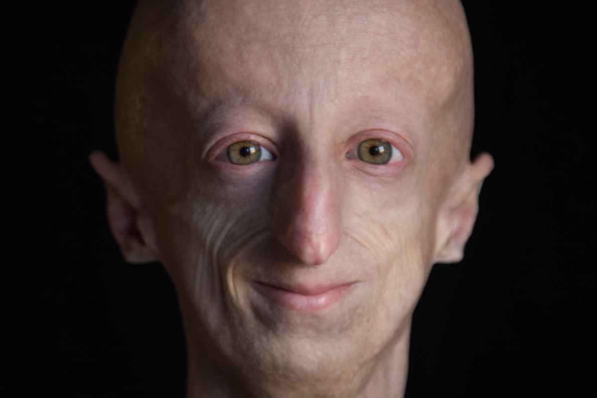 Sammy Basso, Progeria,Mourir De Vieillesse, 28 Ans